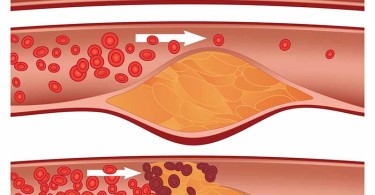 Атеросклероз