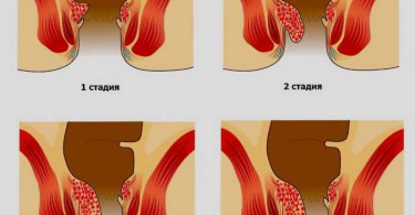 Деликатная проблема: геморрой