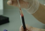 Железодефицитная анемия