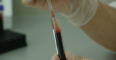 Железодефицитная анемия